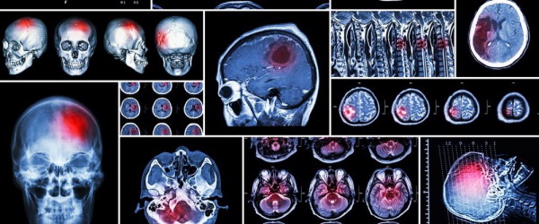 traumatic brain injuries on MRI.