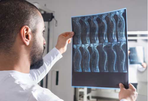Doctor looks at Spinal cord injury x-ray